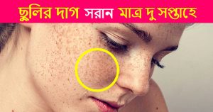 ছুলি থেকে মুক্তির উপায়
